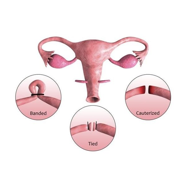 Stocktrek Images StockTrek Images PSTSTK701226HLARGE Biomedical Illustration of A Tubectomy. A Tubectomy is When A Womans Fallopian Tubes Are Blocked To Prevent Implantation of Eggs Poster Print; 35 x 23 - Large PSTSTK701226HLARGE